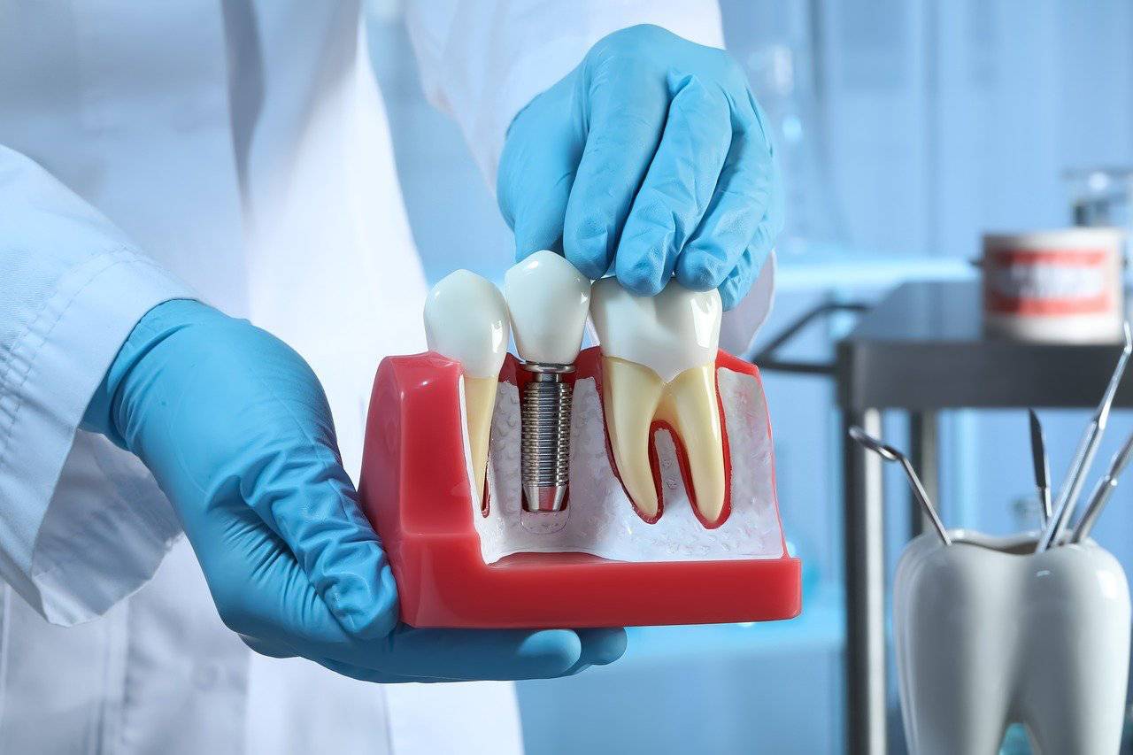 ¿Sabes qué es un implante dental?